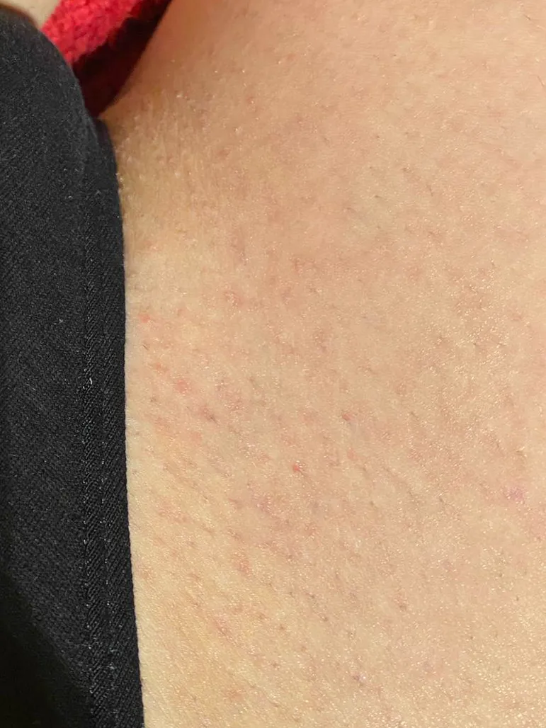 Bikinizone nach 7 Sitzungen Laserbehandlung