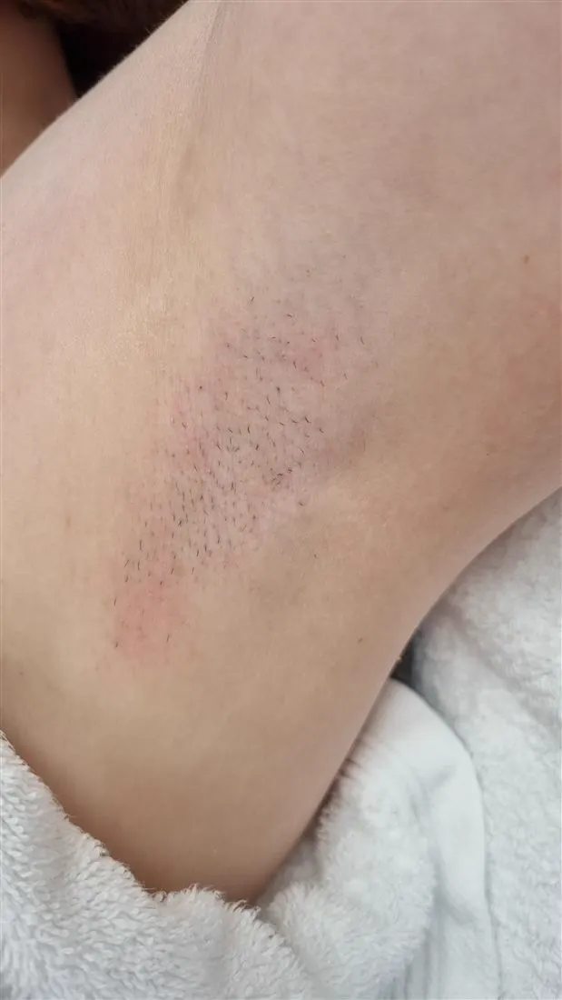 Achseln vor der Laserbehandlung