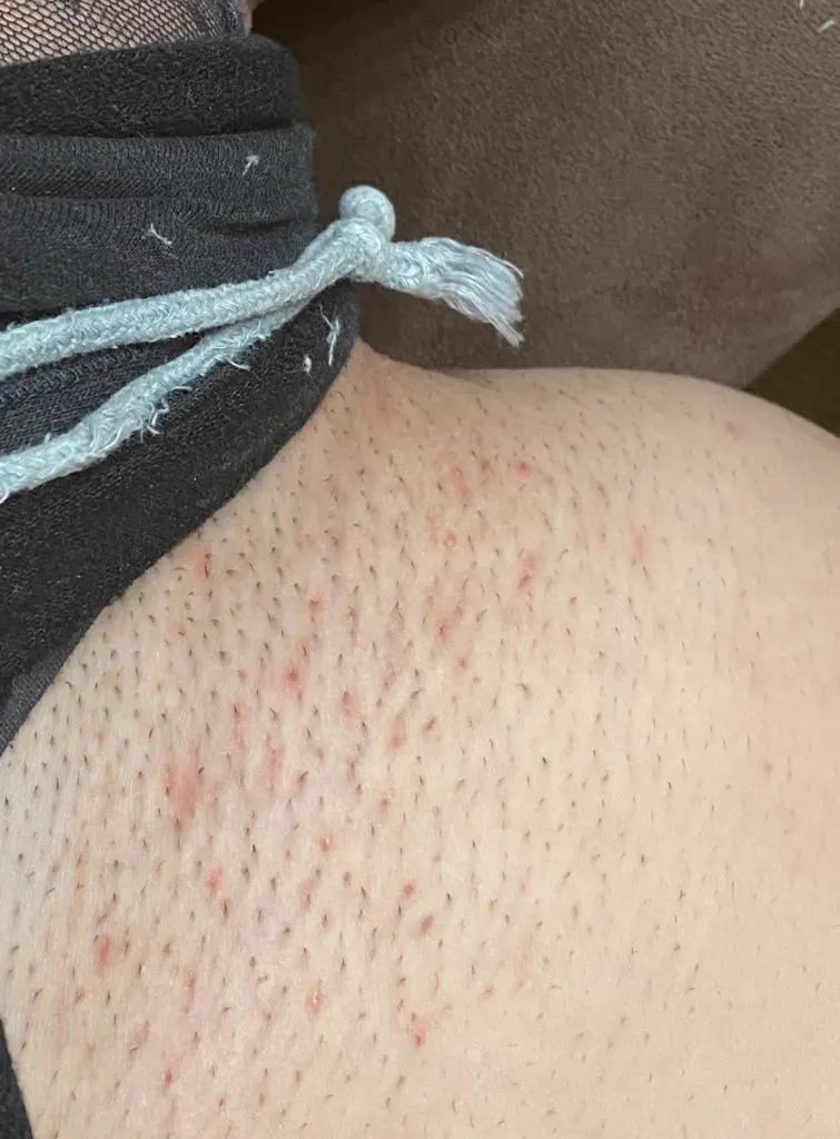 Bikinizone vor der Laserbehandlung